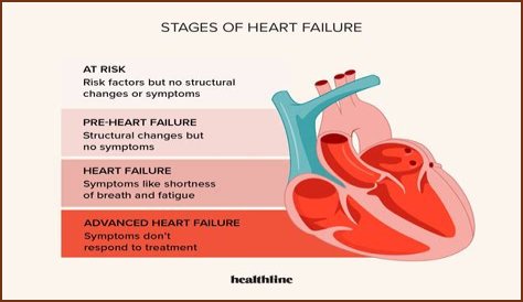 Heart Failure And The Plight Of Extreme Obesity